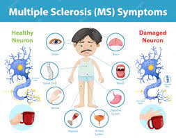 Best supplements, vitamins and nutraceuticals for fatigue in multiple sclerosis (MS)